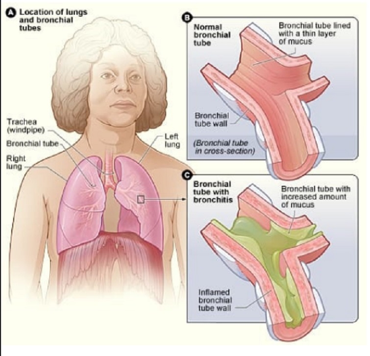 Winter and respiratory diseases